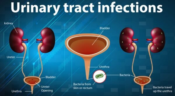 Differences Between UTI and Bladder Infection