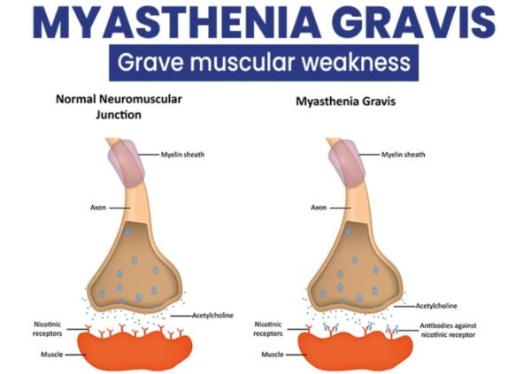 Difference between Myasthenia Gravis and Parkinson Disease